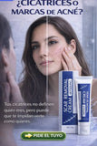 SCAR REMOVAL CREAM - AYUDA A REDUCIR CICATRICES Y MARCAS DE ACNÉ
